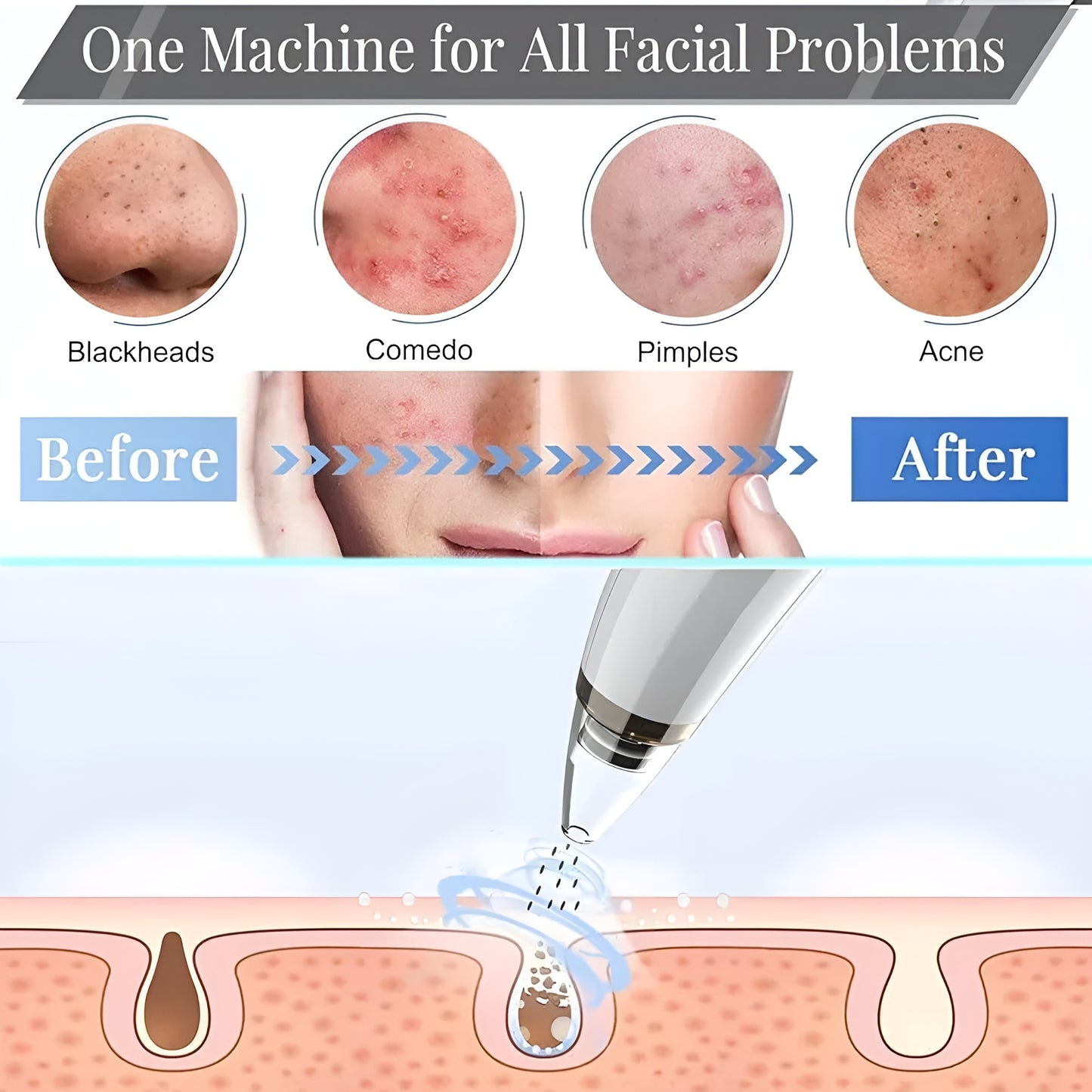 NuVac™ Skin Extractor