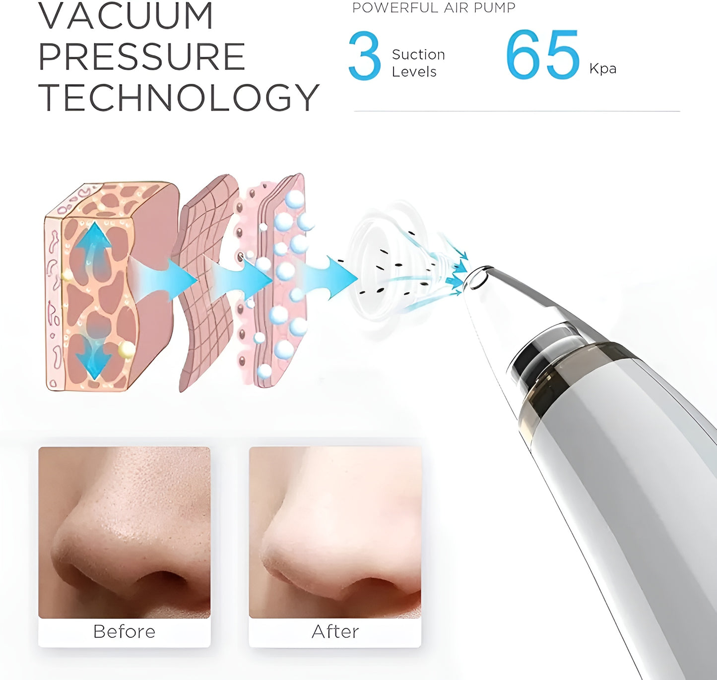 NuVac™ Skin Extractor