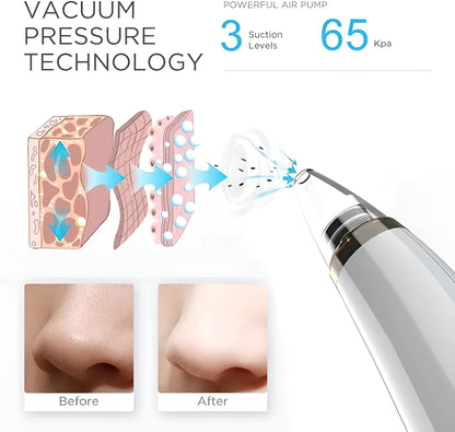 NuVac™ Skin Extractor