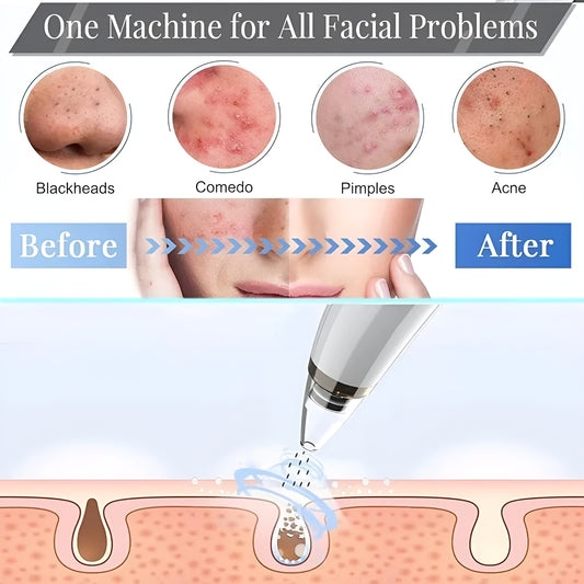 NuVac™ Skin Extractor